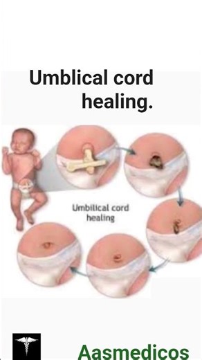 How does a Newborn's Umblical cord heal? #medicaleducation