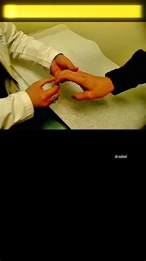 Adeel Ur Rehman on Instagram: "The Finger Flick That Checks Your Spine 🦴 Babinski for the Arms? 👉 This is Hoffmann’s Sign Ever seen a doctor flick someone’s fingernail? That’s Hoffmann’s Sign—a quick test for cervical spinal cord issues. 🩺 👉 How it works: A flick to the middle fingernail can cause the thumb & index finger to jerk inward if there’s possible nerve compression in the neck. 🔍 Key takeaway: Like Babinski for the arms! But note—it can sometimes be normal or point to systemic cond