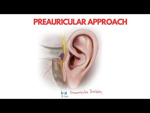 Preauricular Approach | Oral & Maxillofacial Surgery