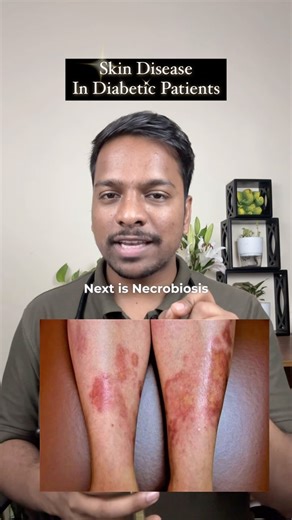 Identifying Diabetic Skin Conditions and Complications This video discusses diabetic dermopathy, a skin condition that can be a marker of diabetes complications like retinopathy, nephropathy, and neuropathy. It also covers necrobiosis lipoidica diabeticorum, a rare skin disorder in diabetics. The video encourages viewers to identify scleroderma in diabetic patients and share the content with friends. #diabeticdermopathy #diabetescomplications #necrobioslipoidicadiabeticum #scleroderma #mbbs #nee