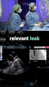 WATCHMAN FLX™ Live: Perfect LAA Compression in Real Time