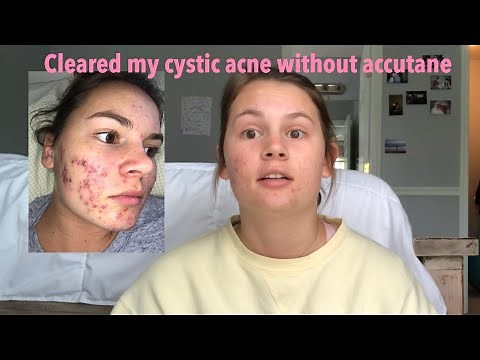 How I cleared my cystic acne without accutane