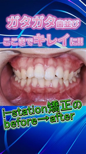 ガタガタ歯並び ガミースマイルも改善!! #歯列矯正 #歯並び #ガタガタ #歯医者