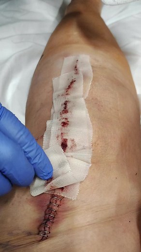 Total Knee Replacement: Pain, Blood Clot & Fear