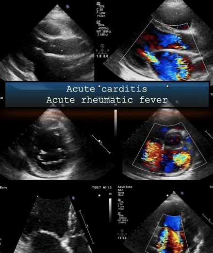 Acute carditis Acute rheumatic fever