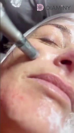 Exosome Microneedling Explained in 60 Seconds | Boost Results with Every Treatment!