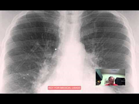 CXR Pulmonary Vascular Congestion Discussed by Radiologist.mp4