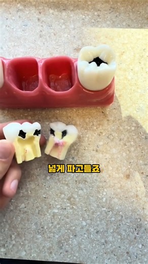 겉은 멀쩡한데 속에서 진행되는 충치
