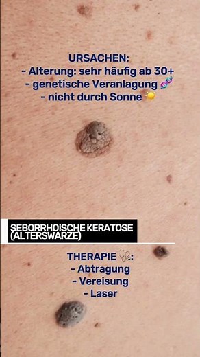 Diese Hautveränderung haben mehr Menschen als gedacht