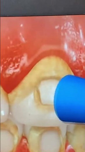 How to prevent white spots or decalcification from forming with braces.