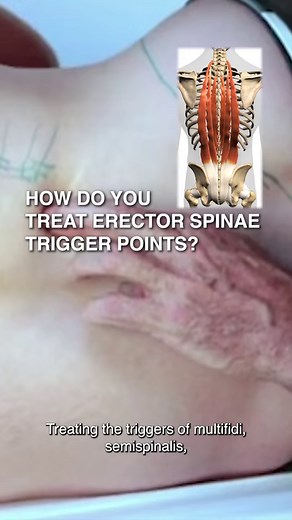 16K views · 348 reactions | How Do You Treat Erector Spinae Trigger...