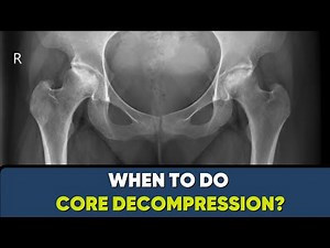 CORE Decompression or Drilling for AVN - To do or not to do?