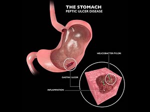Understanding Ulcers: Causes, Symptoms, and Treatment