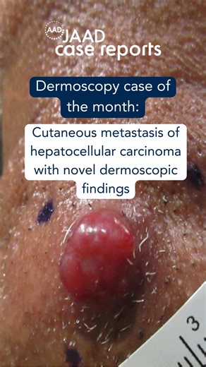 8.9K views · 72 reactions | View the Dermatoscopy Case of the Month and tell us what you think about the case in the comments. ⬇️ https://bit.ly/4fxD3j4 | Journal of the American Academy of Dermatology (JAAD) | Facebook