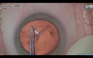 Manual Capsulotomy During Cataract Surgery - Eyetube