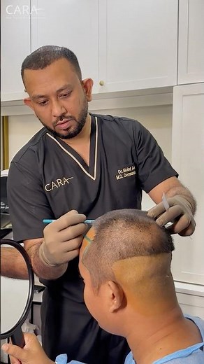 This Hairline Design Will Age Perfectly #hairtransplant #hairrestoration