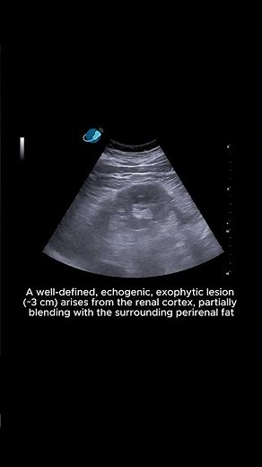 Kidney – Renal Angiomyolipomas – Clip 1 B-mode + Color