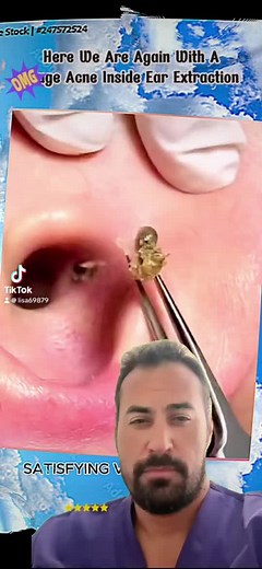 Blackhead Extraction on Ear: A Satisfying Close-Up