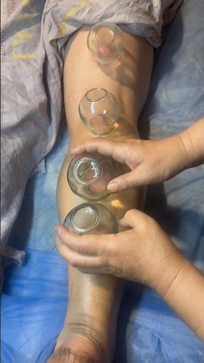 ASMR Thigh Cupping Massage 😌 #asmr #cuppingmassage