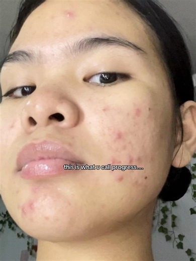 Effective Skincare Routine for Acne-Prone Skin