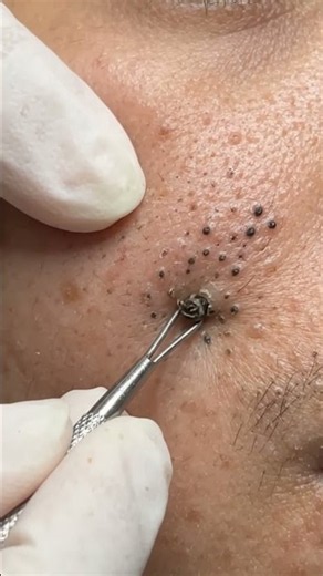 The Deepest Blackhead Extraction 😱 | Pure Skin Lab #MacroSkin #PoreCleaning #BlackheadExtraction