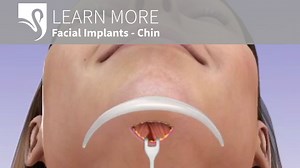 Facial Augmentation Ocala FL - Chin & Cheek Villages
