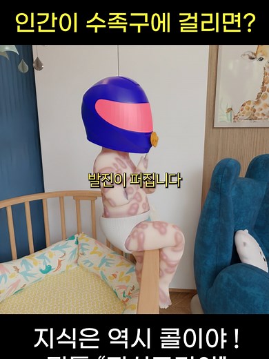 인간이 수족구에 걸리면 나타나는 증상