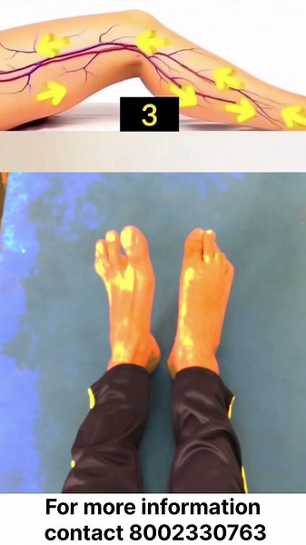 Try these easy moves for varicose vein relief ✅ #viralreels #varicoseveins #yoga #trending #viral