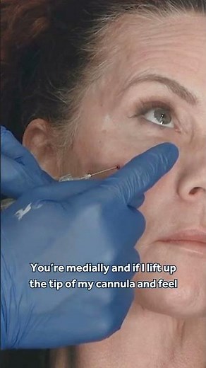 Live Evidence-Based Tear Trough Filler Injection Technique for Aesthetic Practitioners 💎 GEM© Clinic