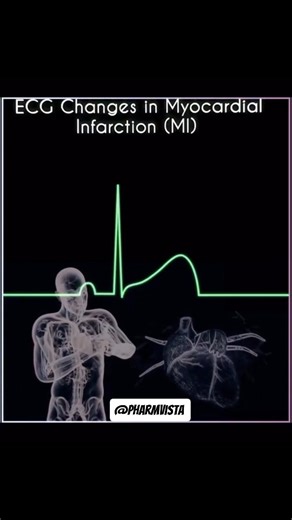 PharmVista Official on Instagram: "Myocardial Infarction (MI), commonly known as a heart attack, occurs when blood supply to a part of the heart muscle is suddenly blocked, leading to ischemia and necrosis. ECG (Electrocardiogram) is one of the most important and fastest tools to diagnose MI and to understand its stage. Let’s understand the ECG wave changes step-by-step 👇 P Wave Atrial depolarization Q Wave Initial ventricular depolarization (Pathological Q wave → myocardial necrosis) R Wave Ma