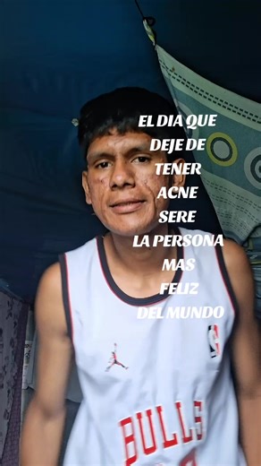 ACNÉ 😩 #Tik TOK #