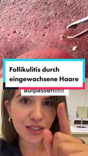 Follikulitis durch eingewachsene Haare - Hautärztin erklärt