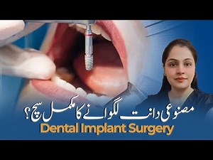 Dental Implant Myths – Immediate vs Delayed Implant | Full Tooth Implant Procedure & Care Tips