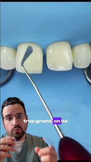 How to close an incisal diastema with composite in an aesthetically pleasing and durable way?