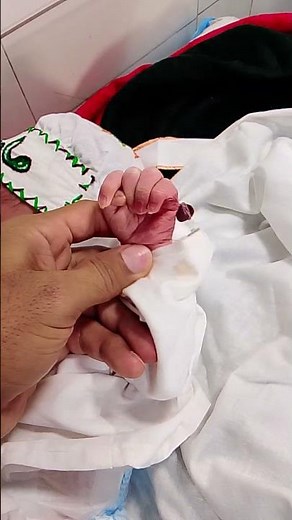 Newborn baby with extra finger is called Polydactyly.Polydactyly is a condition where a baby is