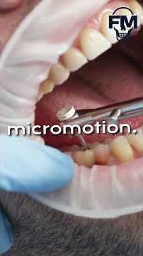 🦷 Immediate vs delayed loading—timing decides implant success! 💡 #DentalImplants #Dentistry #Shorts