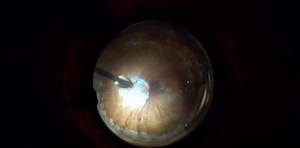Subretinal Injection of tPA Myopic Staphyloma - Eyetube