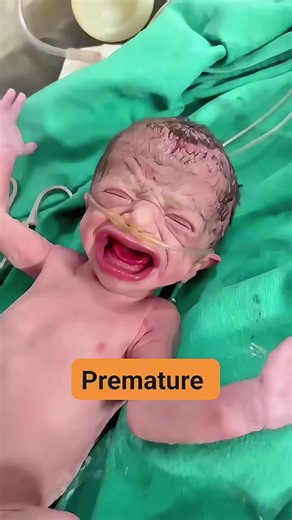 28-Week Premature Baby 👶💛 | Tiny Fighter, Big Miracle. #TikTokGrowthChallenge#PrematureBaby#28Weeks#NICU#creatorsearchinsights