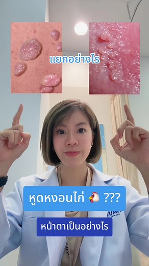 เข้าใจหูดหงอนไก่และความแตกต่างกับ vestibular papillomatosis