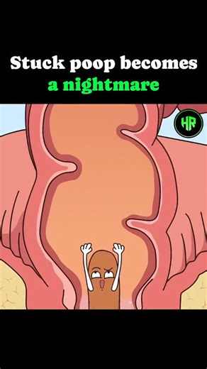 Healthrivex | Daily Health Tips on Instagram: "This hilarious animation reveals the tragic fate of a piece of poop that gets left behind. While his friend "Diarrhea" makes a quick escape, the stuck stool lingers too long and transforms into a painful perianal abscess. It is a funny yet gross look at what can happen inside your body when things don't move smoothly! The situation quickly escalates until a doctor has to intervene surgically. The video ends with a laugh-out-loud moment where the pat