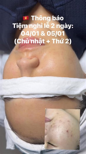Linh My Đặng Spa - Chuyên Nặn Mụn Phan Thiết on Reels
