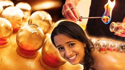 Why athletes swear by fire cupping