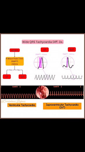 75K views · 591 reactions | 變 Wide QRS Tachycardia: Differential Diagnosis ⚡️ #ECG #Tachycardia #MedicalEducation | Abdallah Othman | Facebook
