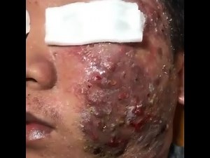 BIG PIMPLE POPPING Crazy EXPLOSION! VIDEO COMPILATION Watch Till The End