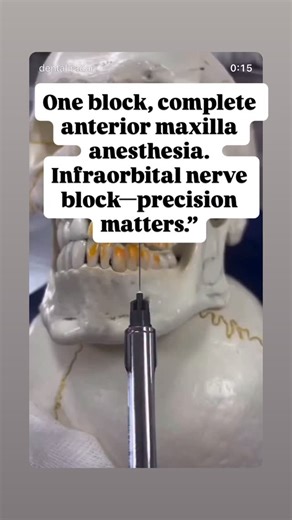 Dr adhya thakur arora on Instagram: "Want to numb the entire upper anterior region with one shot?” VO: “Try the infraorbital nerve block! Target the foramen just below the infraorbital rim. Insert at the mucobuccal fold over the premolar, advance toward the foramen, aspirate, inject 1 ml, and apply pressure. ❤️The infraorbital nerve is a branch of V2 (maxillary division) of the trigeminal nerve. An infraorbital block numbs: • 🦷 Maxillary incisors • 🦷 Canine • 🦷 Premolars (variably the MB root