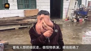 125K views · 2.3K reactions | China's 'Elephant Man' is now struggling to lead a normal life after five life-saving operations to remove the world’s biggest facial tumor. For more details, click in: https://news.cgtn.com/news/3d6b6a4d32636a4d/share.html?t=1488341292121 | CGTN | Facebook