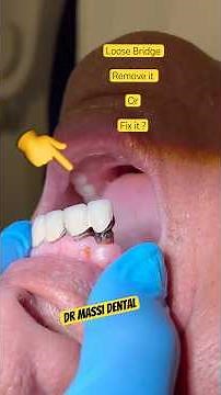 Loose Dental Bridge ! Remove it or fix it