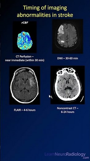 Timing of #imaging abnormalities in #stroke
