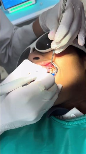 Say Goodbye to a Gummy Smile! | Laser Gingivectomy at Sudha Dental by Dr. Sudharani.