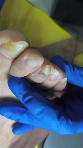 61K views · 345 reactions | The toenails are a bit long. Professional pedicure- | Ingrown Toenails | Facebook